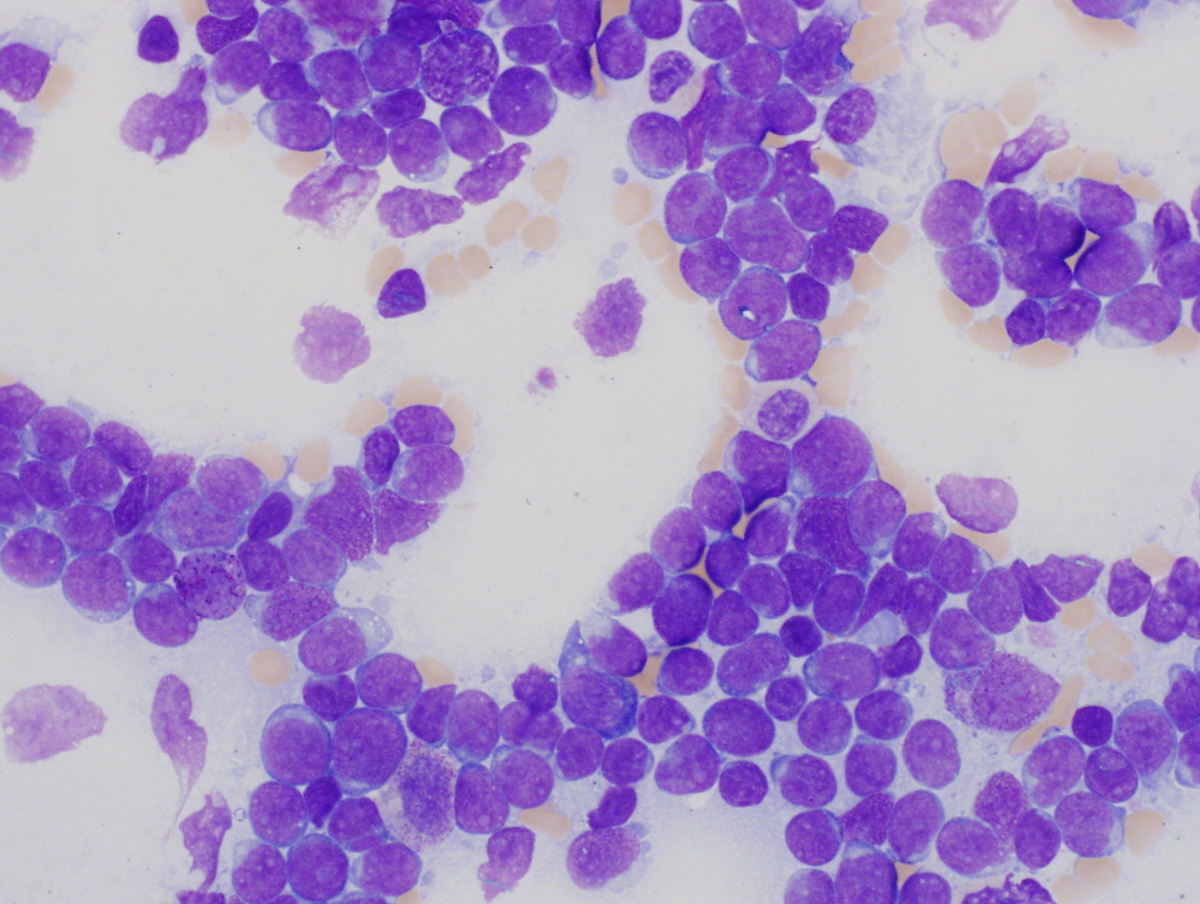 Bone marrow Aspirate, Wright-Giemsa, 60X